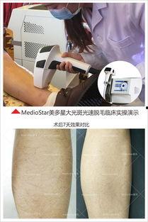 激光脱毛的视频,告别毛发烦恼，尽享丝滑肌肤